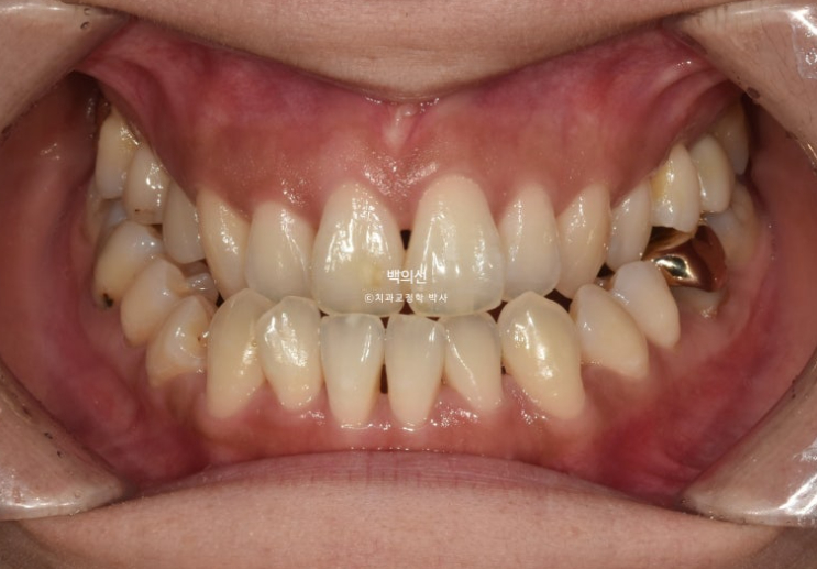 30대 비수술 비발치 주걱턱 부정교합 인비절라인 교정 관련 이미지 2