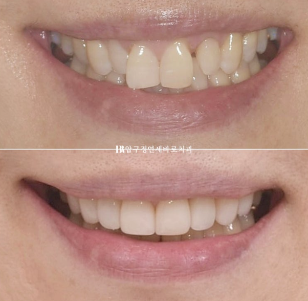 50s Invisalign Lite No-Prep Laminate Bunny Teeth image 16