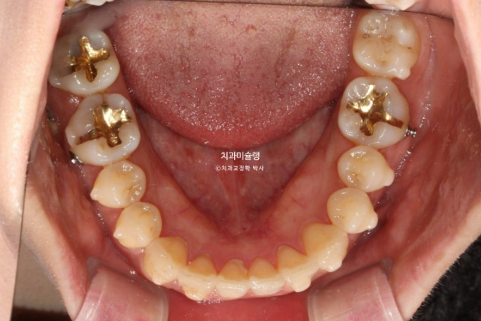 비발치 돌출입 인비절라인 교정 가위교합 중심선 맞추기 관련 이미지 17