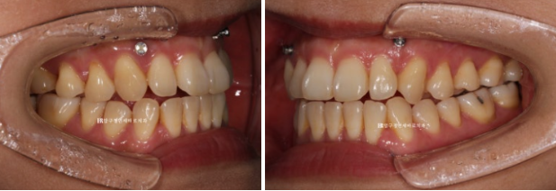 Is Invisalign Treatment Possible After Double-Jaw Surgery? A Real One-Year Case of Surgery-First Orthodontic Treatment image 5