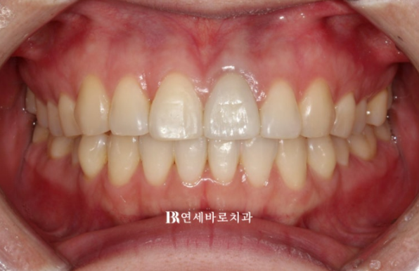 임플란트 없이 자연치아 살리기 앞니 부분교정 보철교정 관련 이미지 5