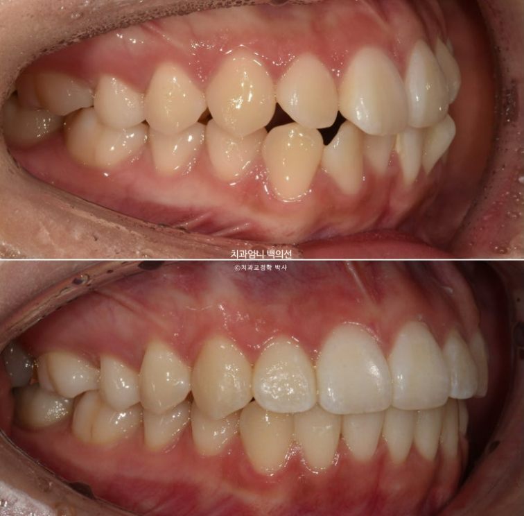 앞니 부분 교정 급속 교정 토끼이빨 MTA 미니튜브 치간삭제 치료기간 9개월 관련 이미지 14