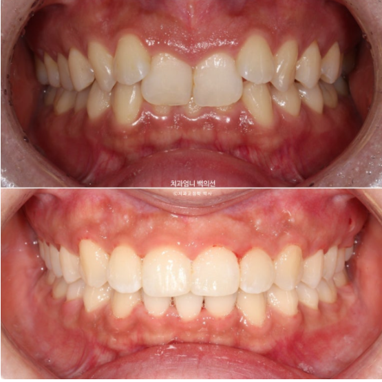 Inward-Tilted Teeth Orthodontic Treatment Review | A Real Case of Treating Congenitally Missing Lower Incisor (Three Lower Front Teeth) Without Extractions image 10
