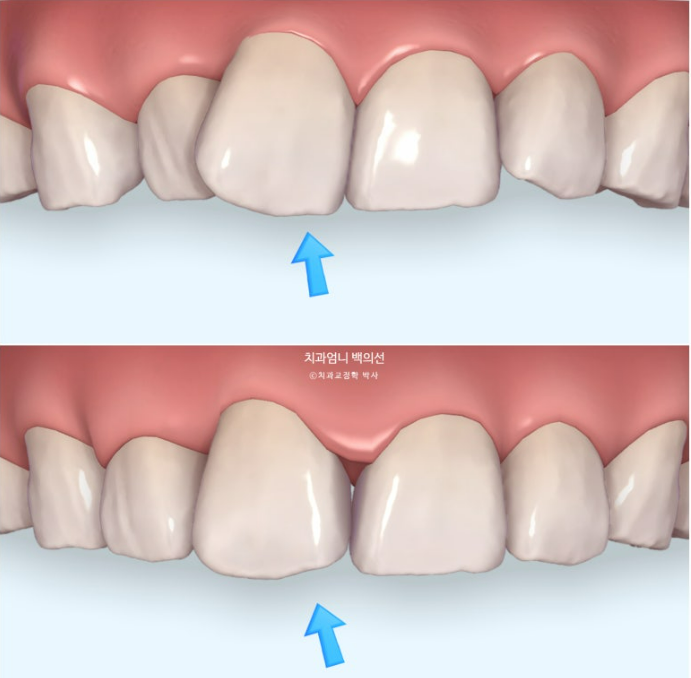 앞니 부분교정 덧니 교정 블랙트라이앵글 부정교합 마모 시뮬레이션 치료기간 5개월 관련 이미지 8