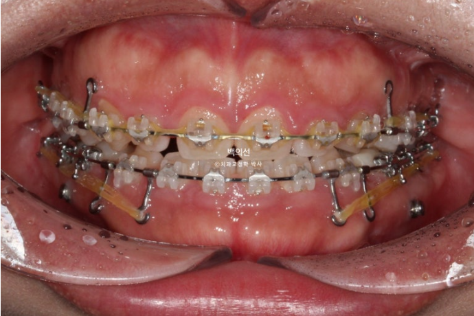 30대 치아교정 돌출입 교정 :: 잇몸미소 거미스마일 교정 입술부전증 결손치 무턱교정 관련 이미지 9