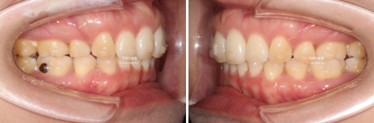 돌출입 덧니 발치 교정 인비절라인 교정 후기 관련 이미지 17