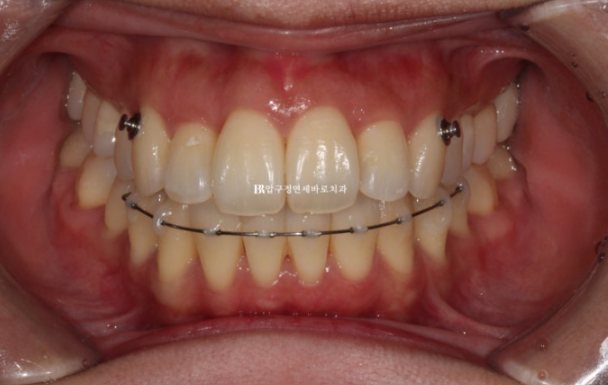 예비신부 교정 단기 앞니 부분교정 치료기간 6개월 관련 이미지 8