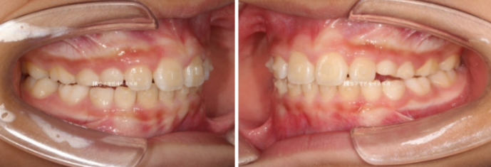 무턱교정 어린이 투명교정 인비절라인 퍼스트 교정 후기 관련 이미지 14