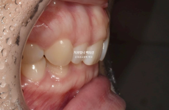 Inward-Tilted Teeth Orthodontic Treatment Review | Actual Case Improved with Non-Extraction Orthodontic Treatment for Gummy Smile, Deep Overbite & Gum Asymmetry — Gangnam Orthodontic Clinic image 4