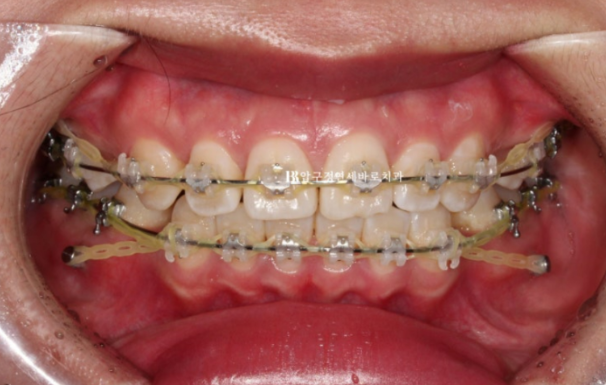 돌출입 교정 입동굴 클리피씨 교정 후기 관련 이미지 5