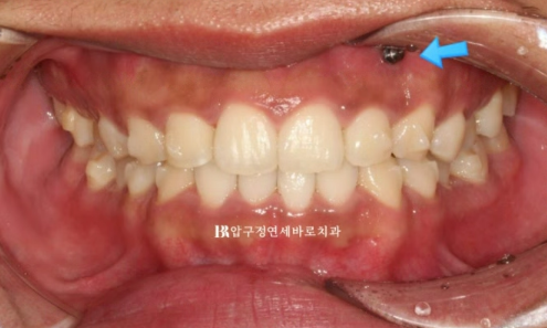 압구정 인비절라인 라이트 과개교합 후기 관련 이미지 6