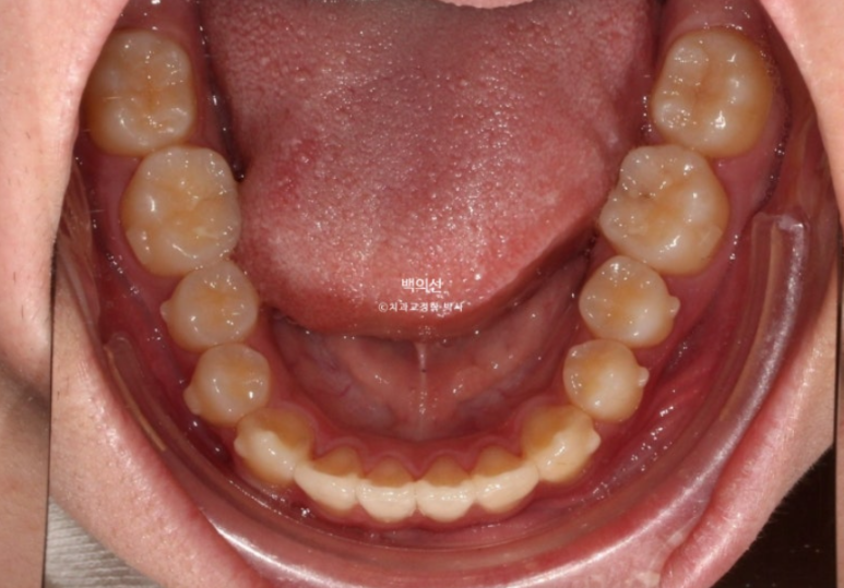 유학생 교정 덧니 반대교합 인비절라인 라이트 치료기간 관련 이미지 10