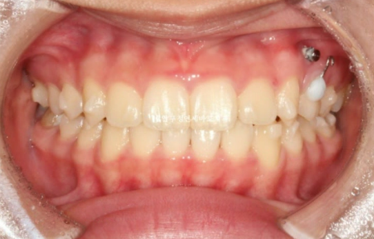 어린이 투명교정 인비절라인 틴 덧니 교정 후기 관련 이미지 9