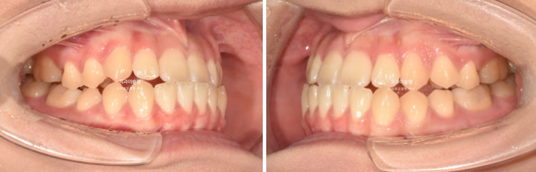 비발치 비수술 주걱턱 반대교합 재교정 치료 관련 이미지 3