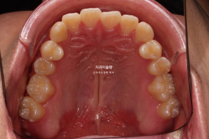 비수술 비발치 주걱턱 절충치료 클리피씨 개방교합 반대교합 치료 관련 이미지 4