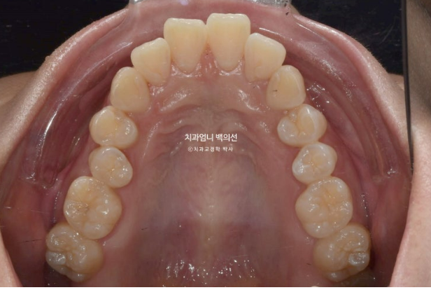 인비절라인으로 발치교정이 가능할까요? 돌출입&middot;과개교합 발치교정 증례 관련 이미지 5
