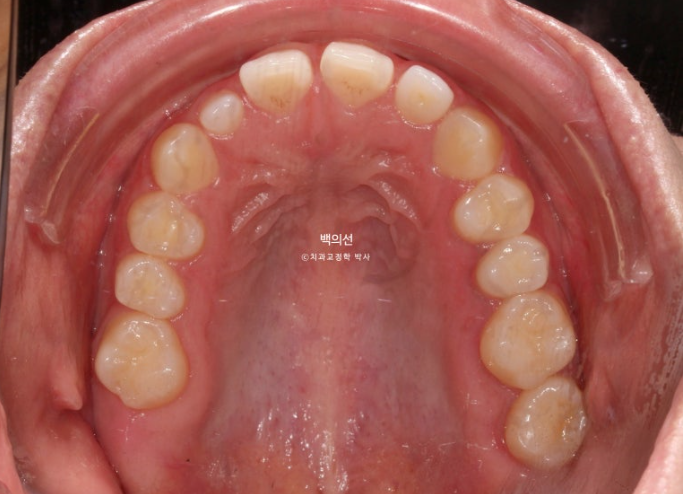 30대 치아교정 돌출입 교정 :: 잇몸미소 거미스마일 교정 입술부전증 결손치 무턱교정 관련 이미지 6