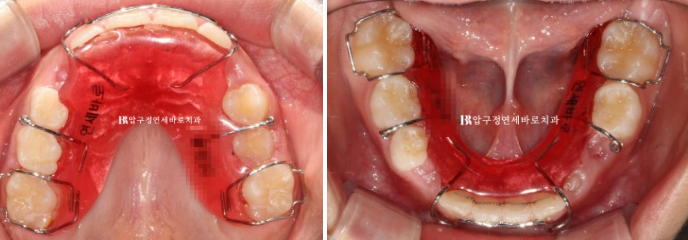 Invisalign First Correction for a Retruded Chin in a Child Orthodontic Treatment for Protrusion image 20