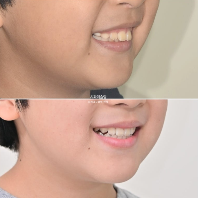 어린이 돌출입 교정 무턱 투명교정 인비절라인 퍼스트 관련 이미지 26