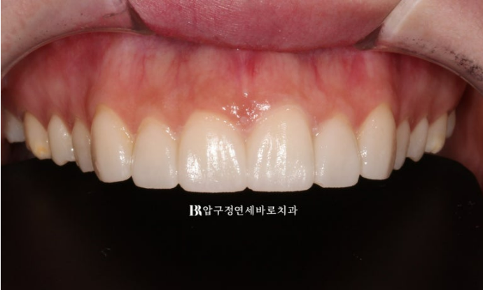 스마일라인 개선 무삭제 라미네이트 실제 두께 ? 관련 이미지 7