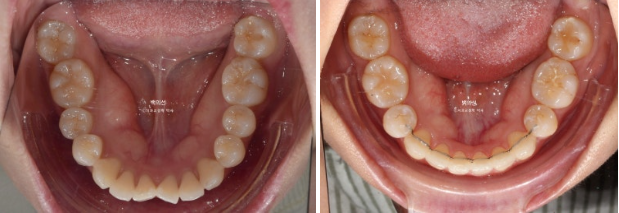 30대 돌출입 덧니 교정 인비절라인 발치교정 후기 관련 이미지 16