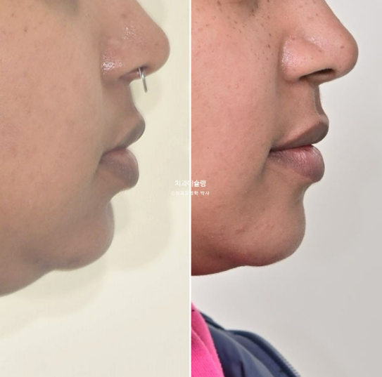 Extraction & re-orthodontics with Clippy-C, intrusion for dental implant. 관련 이미지 24