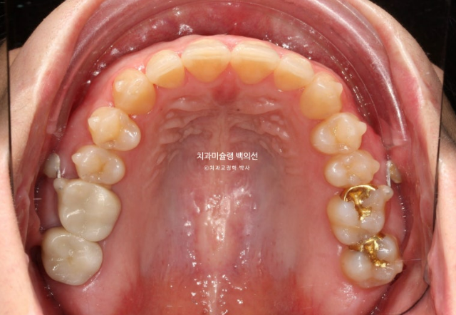 비발치 덧니 교정 인비절라인 과개교합 교정 무삭제 라미네이트 치료 후기 관련 이미지 9