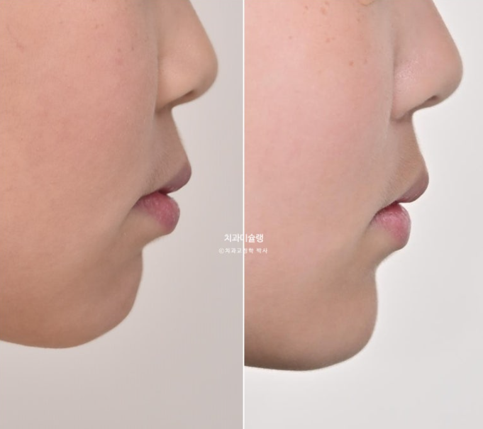 돌출입 비발치 어린이 교정 입술부전증 호두주름 호두턱 토끼이빨 인비절라인퍼스트 관련 이미지 23