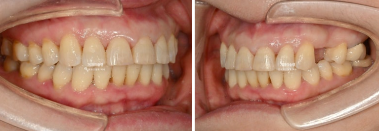 50대 치아교정 돌출 치아벌어짐 중년교정 관련 이미지 13