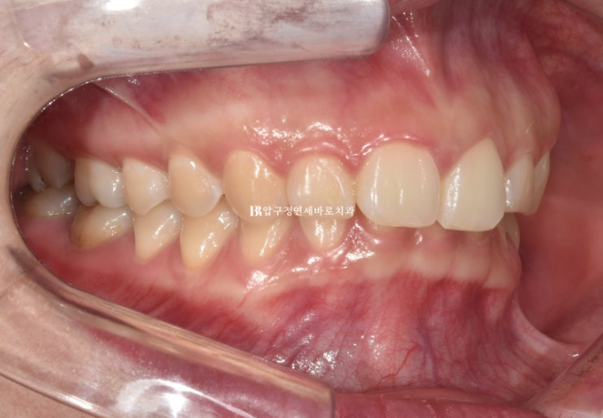 인비절라인 돌출입 발치교정 거미스마일 잇몸미소 교정 관련 이미지 2