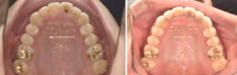 40대 중년 치아교정 인비절라인 라이트 치료기간 8개월 관련 이미지 14