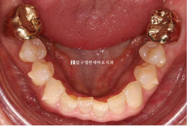 압구정 인비절라인|50대 앞니 부분교정부터 무삭제 라미네이트까지, 자연스러운 미소 완성 관련 이미지 8