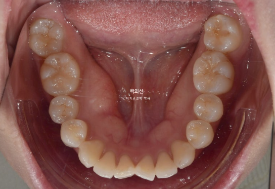 30대 돌출입 덧니 교정 인비절라인 발치교정 후기 관련 이미지 5