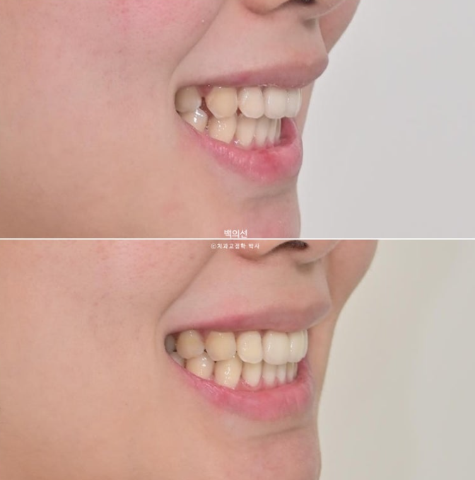 클리피씨 교정에서 인비절라인 변경 마무리 인비절라인 라이트 치료기간 4개월 관련 이미지 15