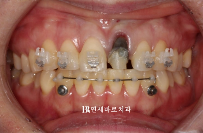 앞니가 부러져 임플란트 해야 한다고 들었는데, 교정으로 살릴 수 있을까요?|보철교정 실제 사례 관련 이미지 3