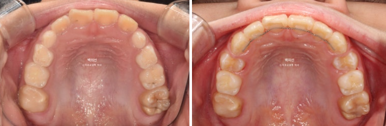 소아 비대칭 교정 인비절라인 퍼스트 재제작 1회 MA 치료 관련 이미지 13