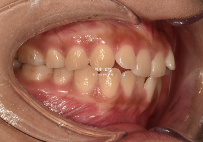 유학생 치아교정 해외거주 한국에서 치아교정? 관련 이미지 3