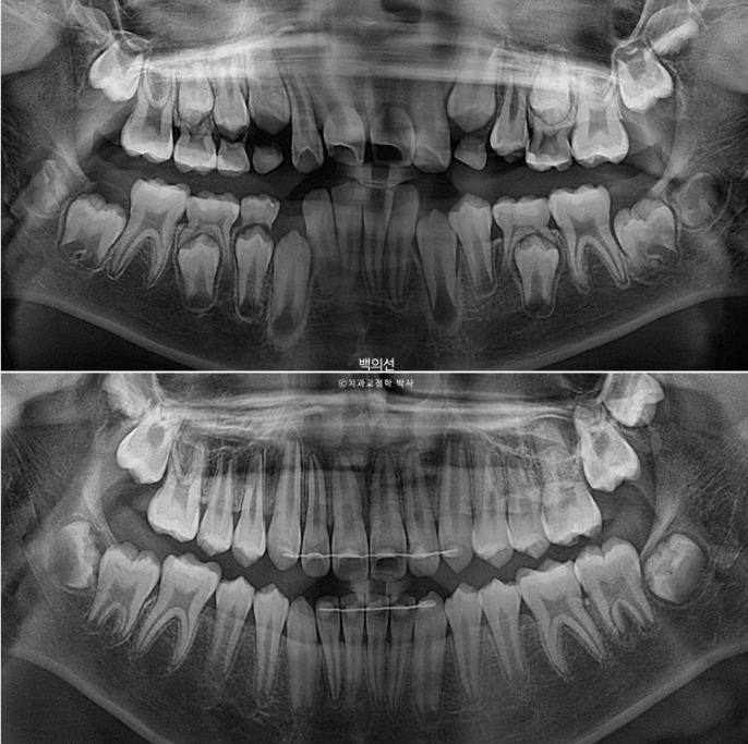 인비절라인퍼스트 어린이 투명교정 과개교합 덧니 악궁확장 돌출 관련 이미지 26