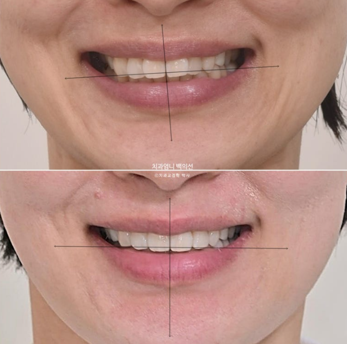 50대 캔팅 교합평면 기울어짐 덧니 교정 인비절라인 라이트 교정? 관련 이미지 14
