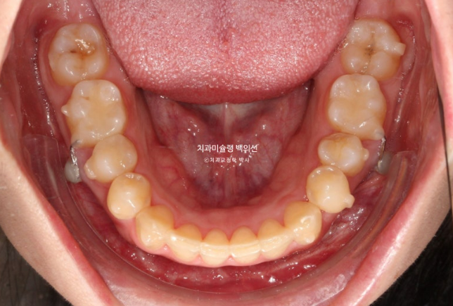 비발치 덧니 교정 인비절라인 과개교합 교정 무삭제 라미네이트 치료 후기 관련 이미지 10