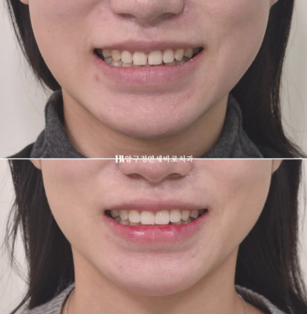 왜소치·원추형 치아, 교정 대신 무삭제 라미네이트로 개선한 사례 관련 이미지 9