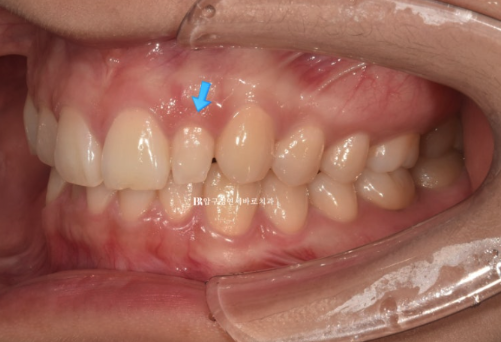 앞니 부분교정은 어떤 경우에 가능한가요? 단기 앞니 부분교정 왜소치 치료 무삭제 라미네이트 관련 이미지 4