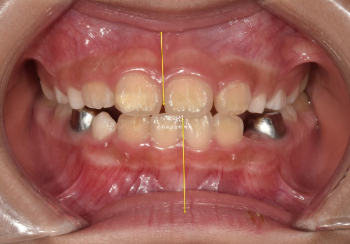 소아 비대칭 교정 인비절라인 퍼스트 재제작 1회 MA 치료 관련 이미지 3