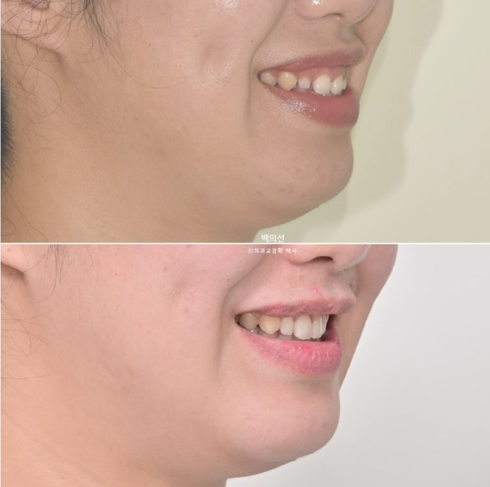 30대 치아교정 돌출입 교정 :: 잇몸미소 거미스마일 교정 입술부전증 결손치 무턱교정 관련 이미지 2