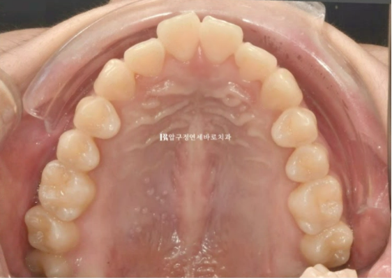 인비절라인 익스프레스 토끼이빨 앞니교정 ? 관련 이미지 3