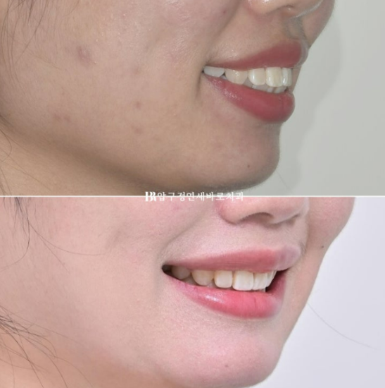 A Review of Extraction Orthodontic Treatment for Protruding Mouth | The Details of Orthodontics That Transform Buccal Corridors and Smile Lines image 15