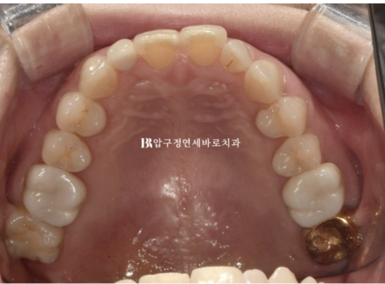 40대 인비절라인 라이트 가위교합, 과개교합까지 10개월 교정 증례 관련 이미지 5