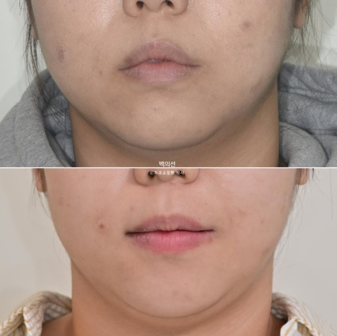 돌출입 교정 인비절라인 발치 교정 개방교합 치료 후기 관련 이미지 25