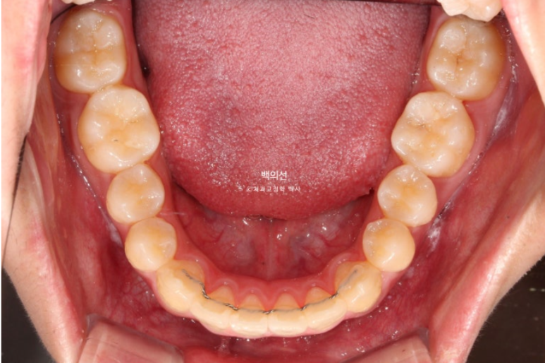 유학생 교정 덧니 반대교합 인비절라인 라이트 치료기간 관련 이미지 14