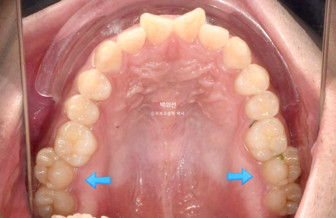 가위교합 나비치아 미니스크류 덧니 교정 인비절라인 라이트 관련 이미지 3